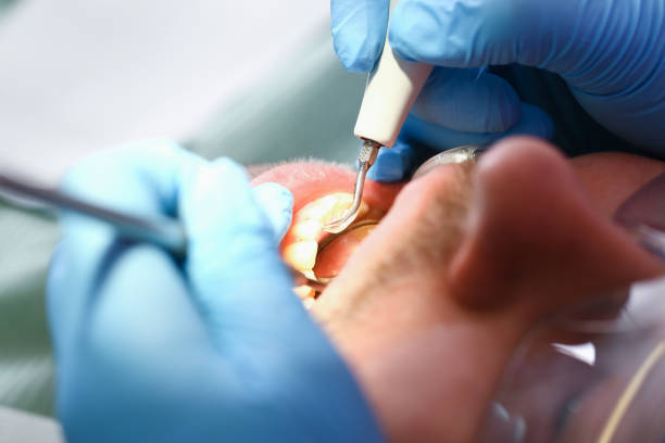 Best Emergency Dental Care for Broken or Chipped Teeth in Urbana, IA