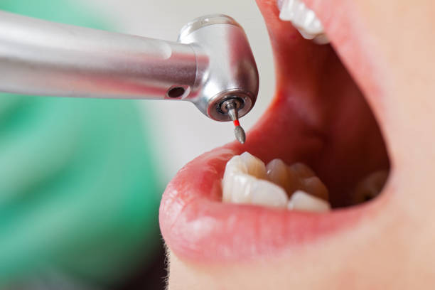Best Emergency Tooth Extraction in Urbana, IA
